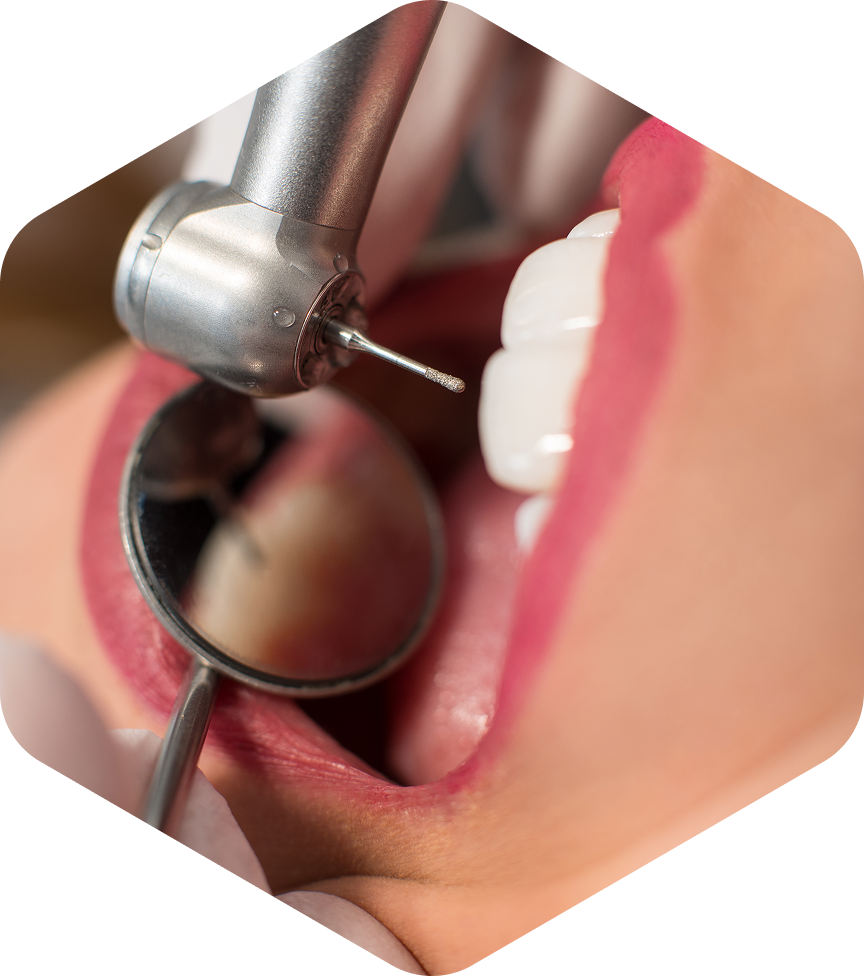Tooth Filling