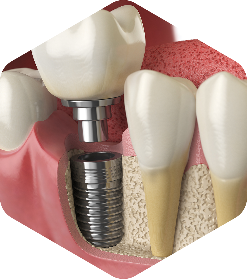 Permanent Dental Implants