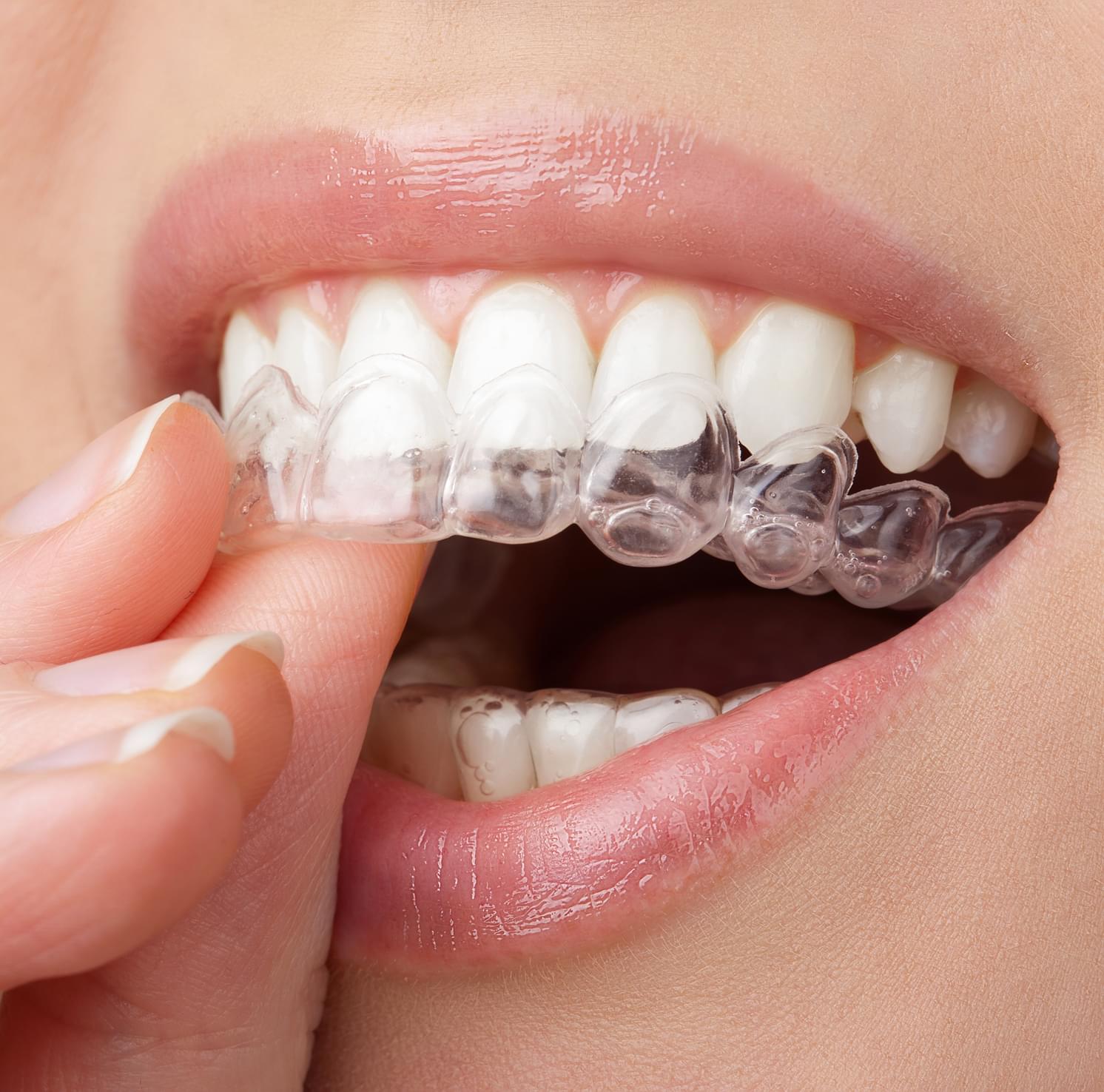 Invisible Aligners