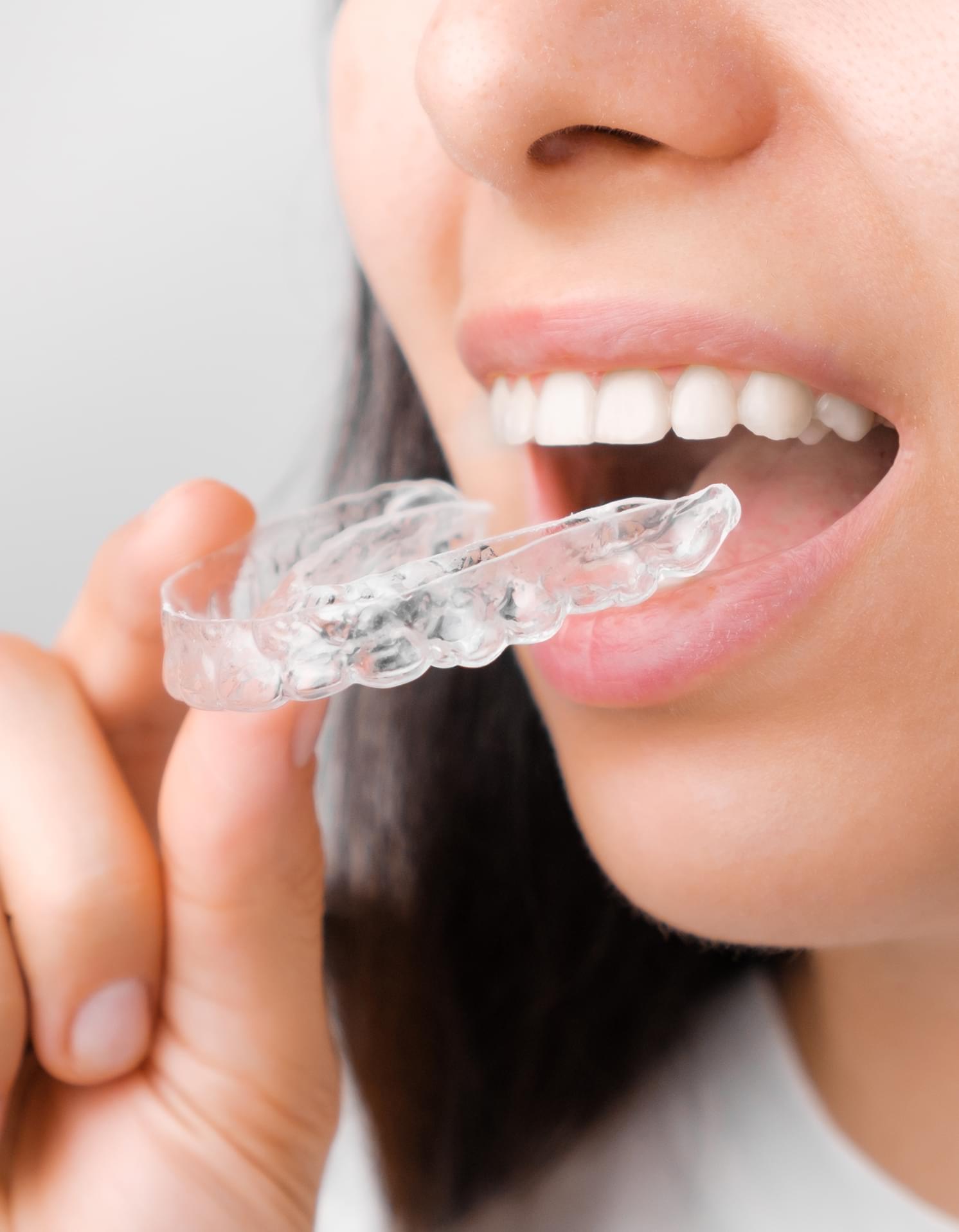 Invisible Braces for Adults