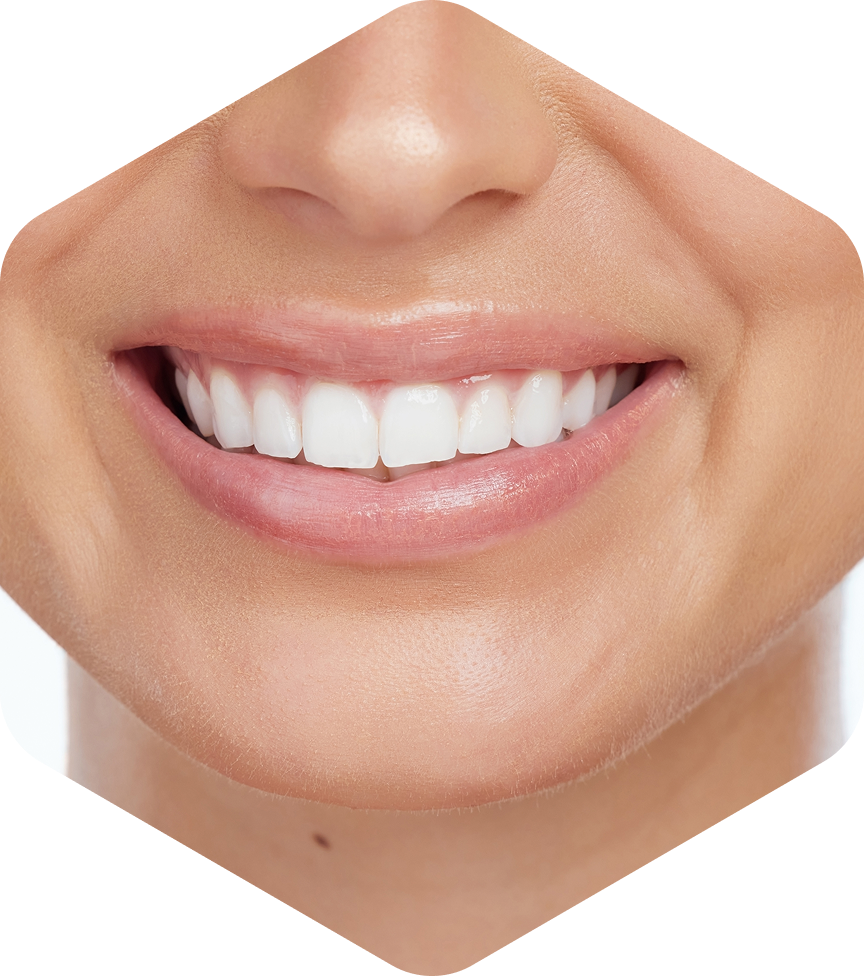 Composite Resin Veneers