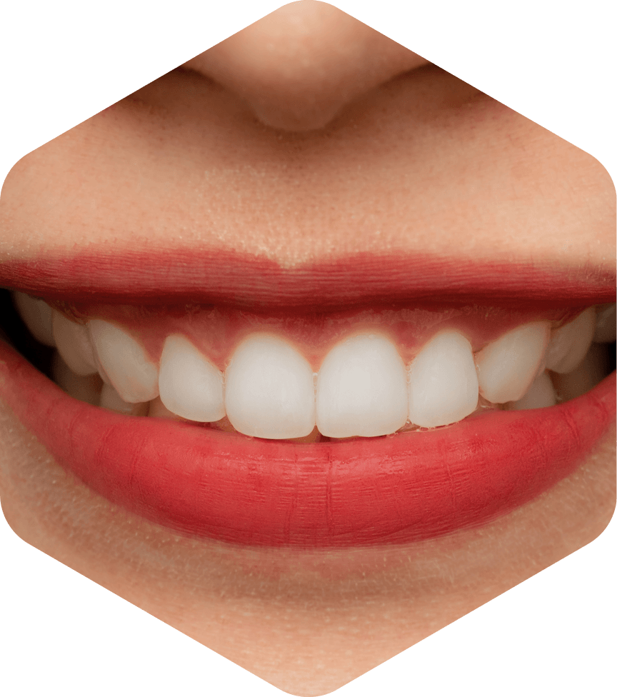 Full Mouth Restoration